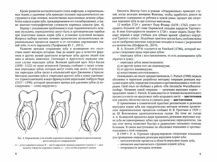 Схема резекции верхушки корня